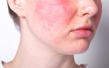 Fața roșie este un simptom …