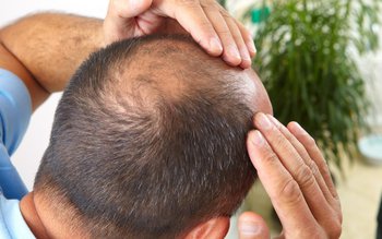 Căderea părului: cum să identifici …