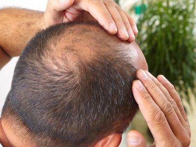 Căderea părului: cum să identifici …