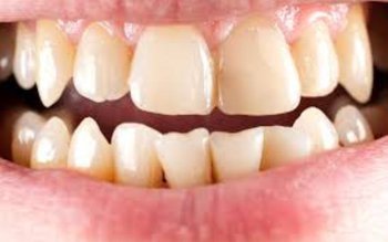 Sfaturi pentru a elimina tartrul …