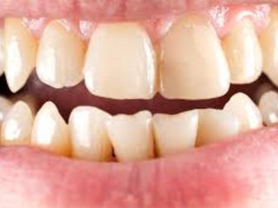 Sfaturi pentru a elimina tartrul …