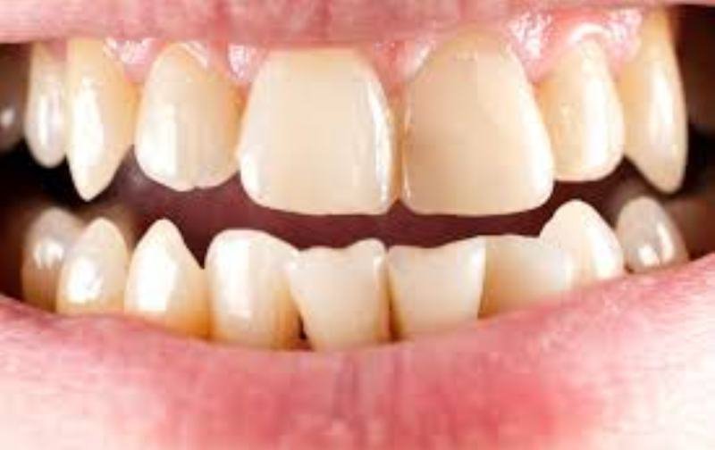 Sfaturi pentru a elimina tartrul dentar în mod natural