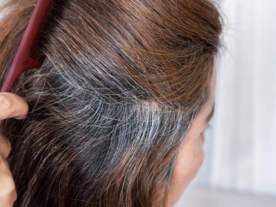 Cauze ale albirii părului de …
