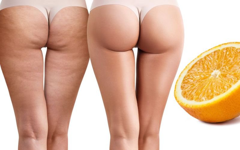 Dieta care ne poate scăpa de celulită