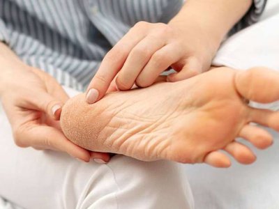 Tratamente naturiste pentru călcâie crăpate: …