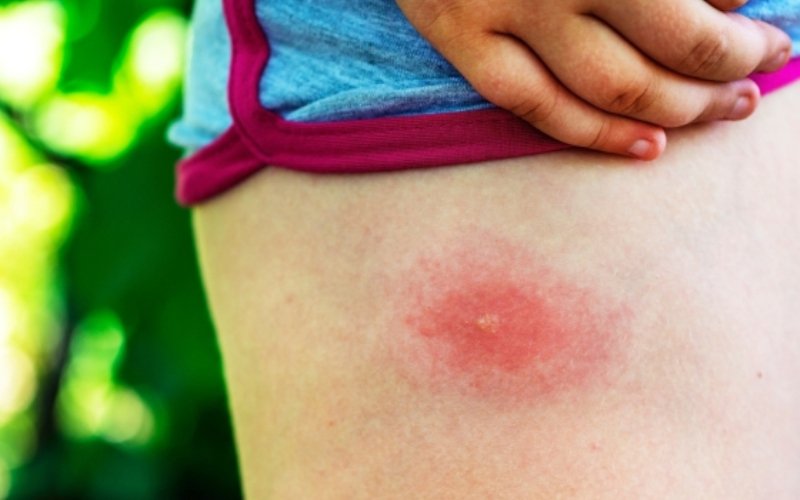 ATENȚIE! O simplă mușcătură de căpușă poate declanșa o alergie puțin cunoscută