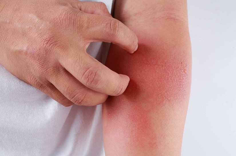 Semne de avertizare că aveți boala Lyme transmisă de căpușe